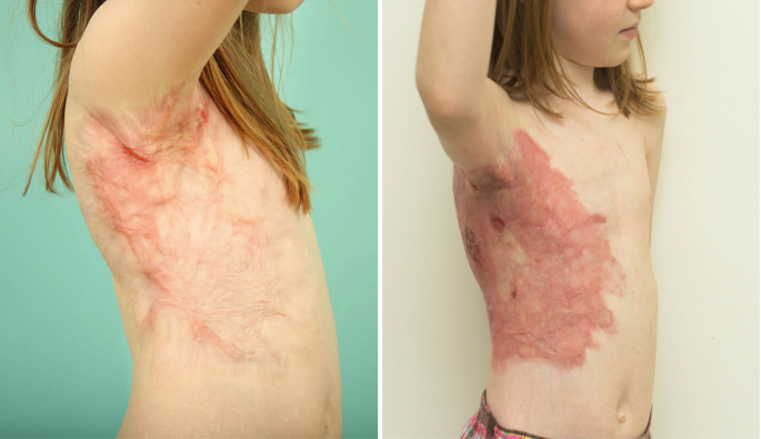 Medazy® ReGenScar Stem Cell Scar Gel